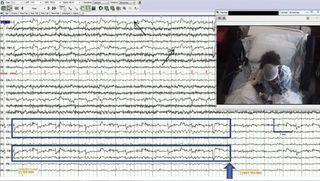 The blue boxes represent the texting rhythm present in a 22-year-old subject who is texting with her right hand. (Image: Mayo Clinic/William Tatum)